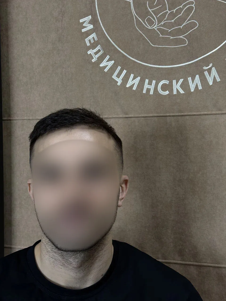 Линия роста волос до пересадки, пациент 1