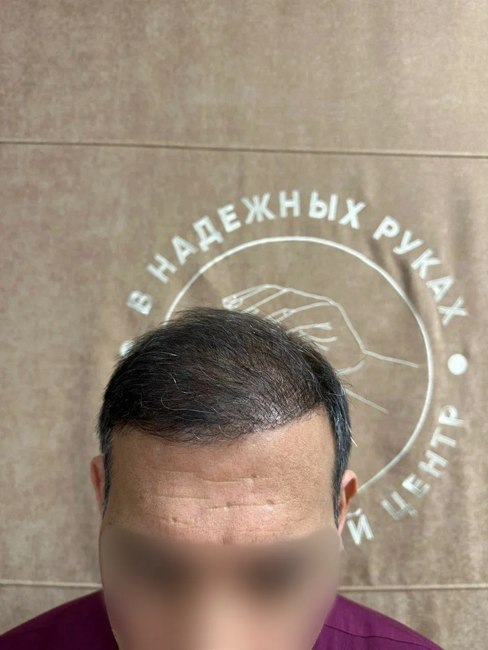 Лобная зона до пересадки волос, пациент 2