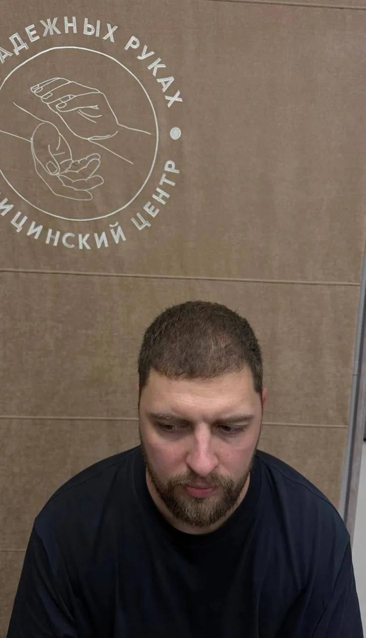 Фронтальная зона до пересадки волос, пациент 5