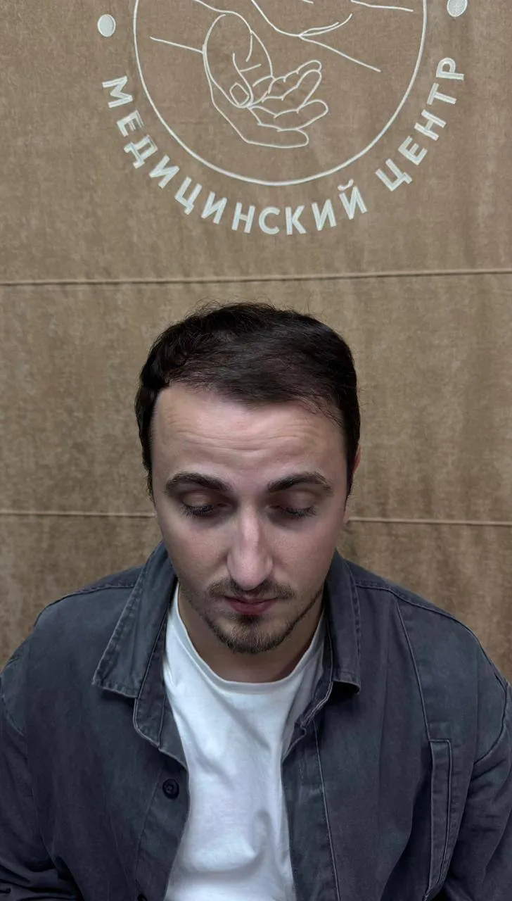Линия лба до пересадки волос, пациент 6