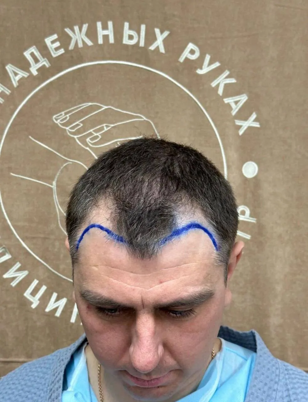 Углы линии роста после пересадки, пациент 8